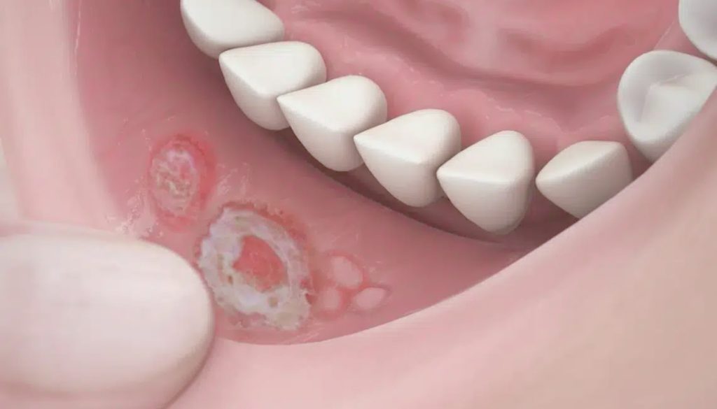 Thông tin chi tiết về môi nổi mụn trắng