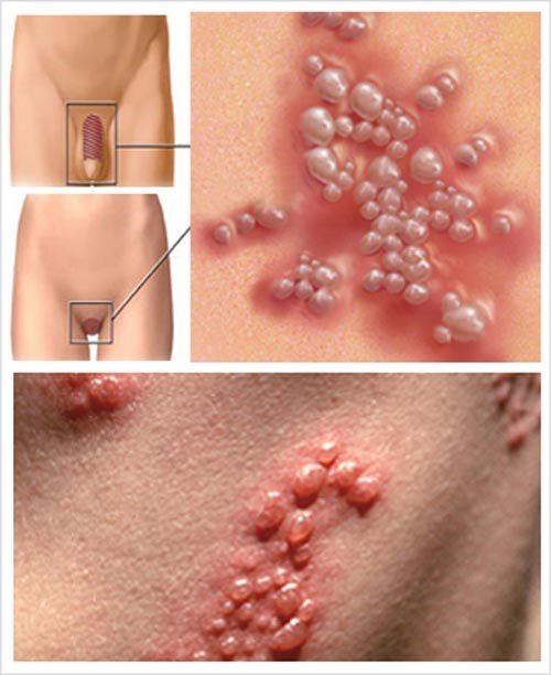 Thông tin chi tiết về herpes sinh dục