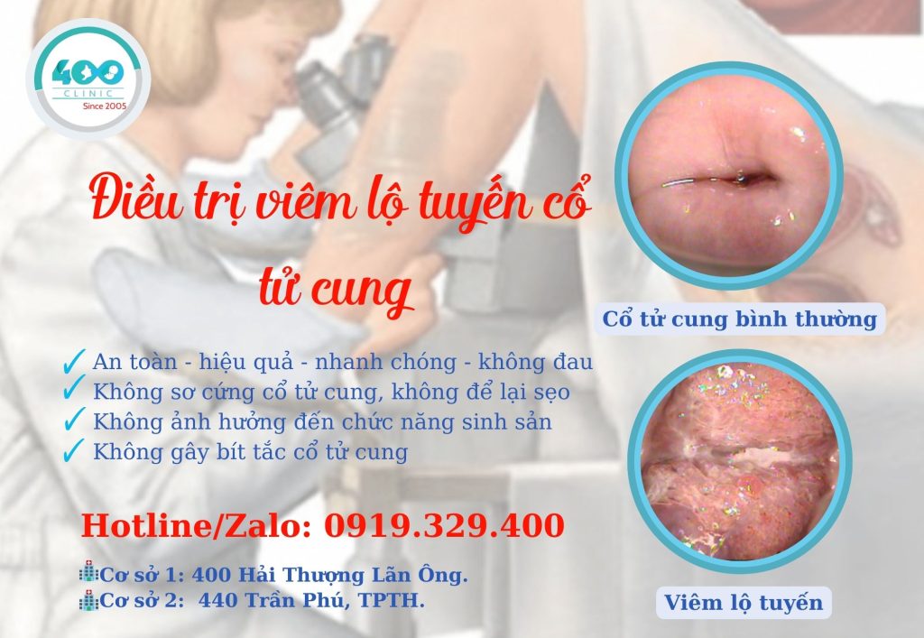 viêm lộ tuyến cổ tử cung nặng