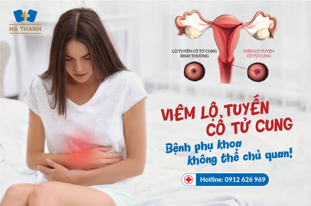 viêm lộ tuyến cổ tử cung nặng