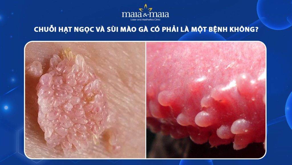 sùi mào gà và chuỗi hạt ngọc