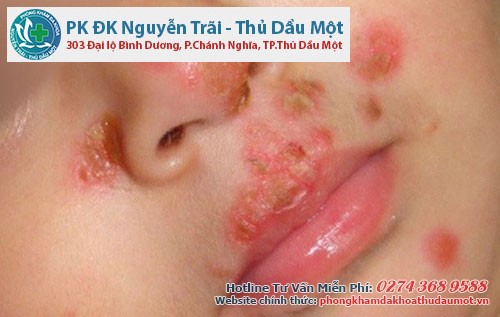 Hình ảnh mụn rộp sinh dục và cách nhận biết bệnh