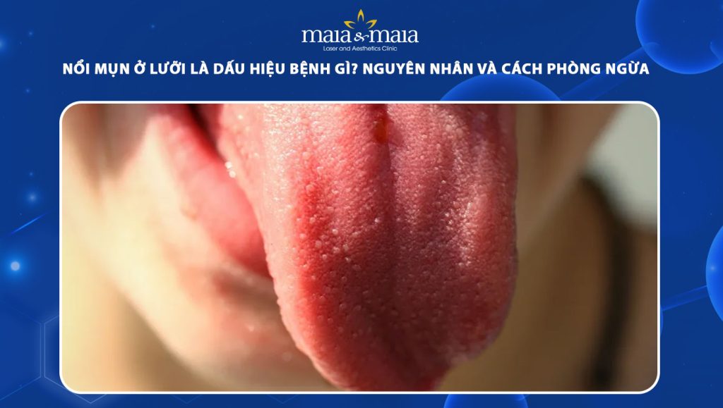 Hình ảnh minh họa nổi mụn ở lưỡi và môi