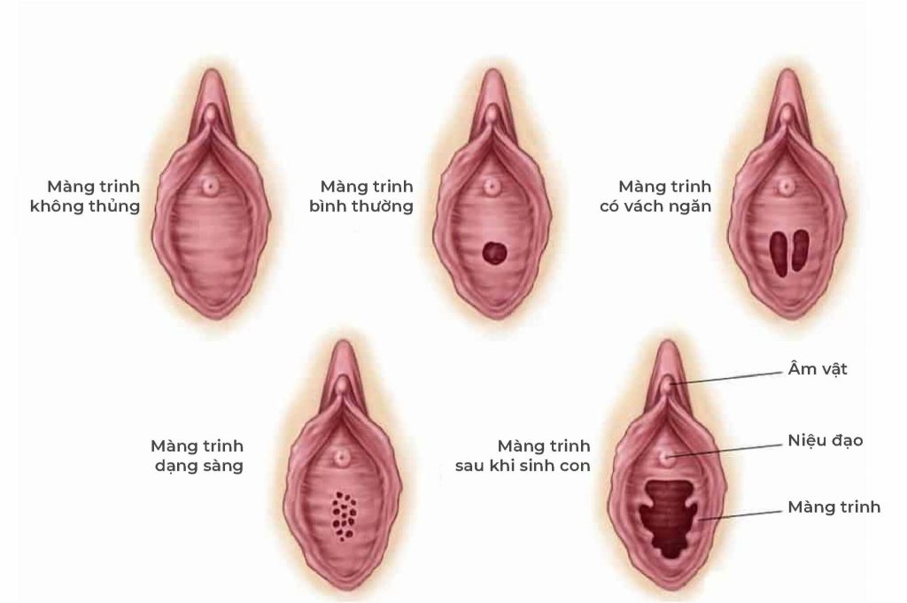 Hình ảnh minh họa cách kiểm tra màng trinh
