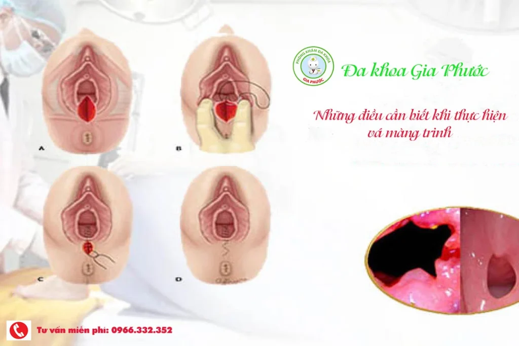 Thông tin chi tiết về cách kiểm tra màng trinh