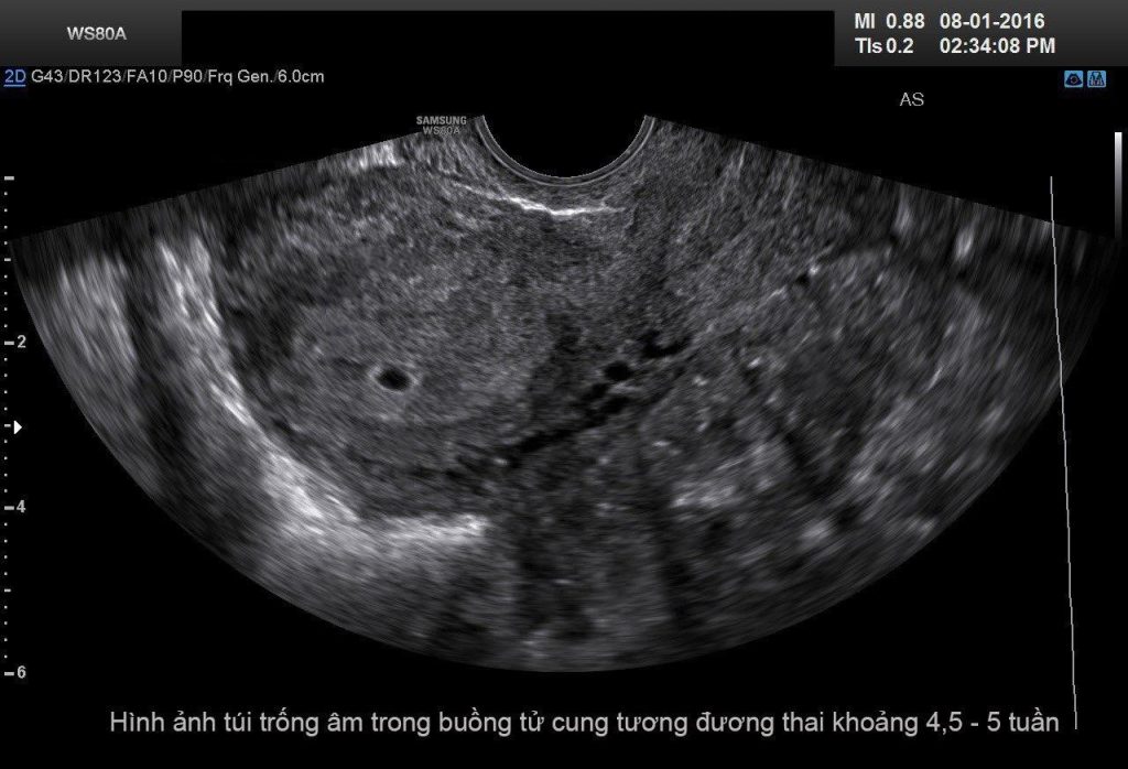 Thông tin chi tiết về chi phí phá thai 3 tuần