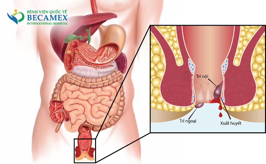 Thông tin chi tiết về bệnh trĩ ở nữ giới