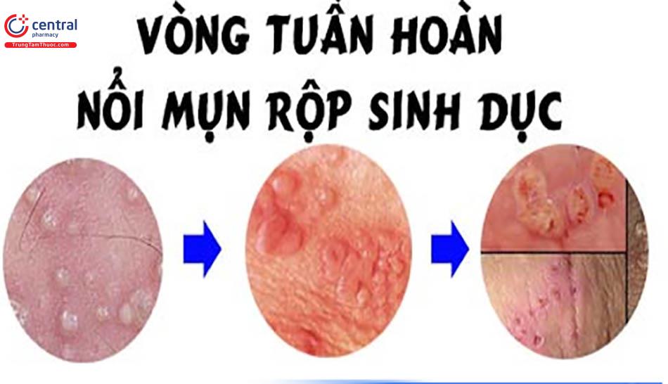 Hình ảnh minh họa điều trị mụn rộp sinh dục