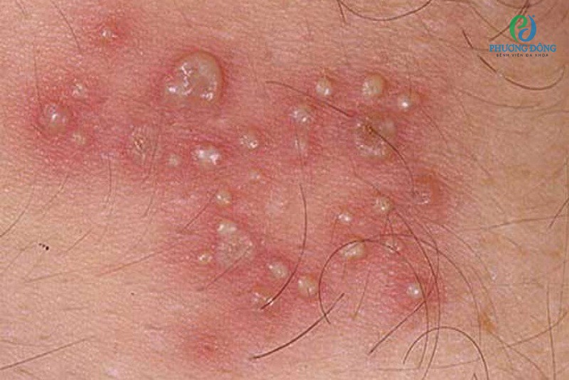 Thông tin chi tiết về điều trị mụn rộp sinh dục