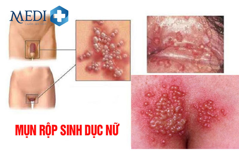 Hình ảnh minh họa hình ảnh mụn rộp sinh dục