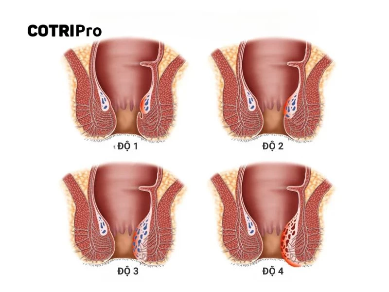 Hình ảnh minh họa trĩ ngoại cấp độ 2