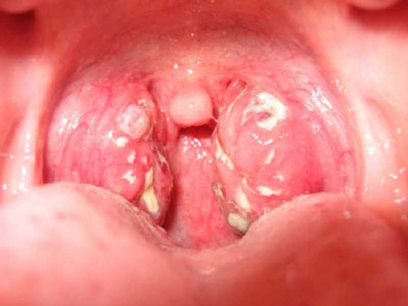 Thông tin chi tiết về hình ảnh mụn rộp sinh dục