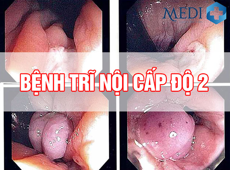 Thông tin chi tiết về trĩ ngoại cấp độ 2