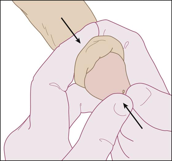Hình ảnh minh họa lột bao quy đầu bị sưng