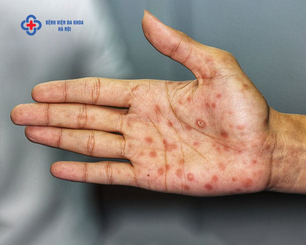 Thông tin chi tiết về giang mai lây qua đường nào