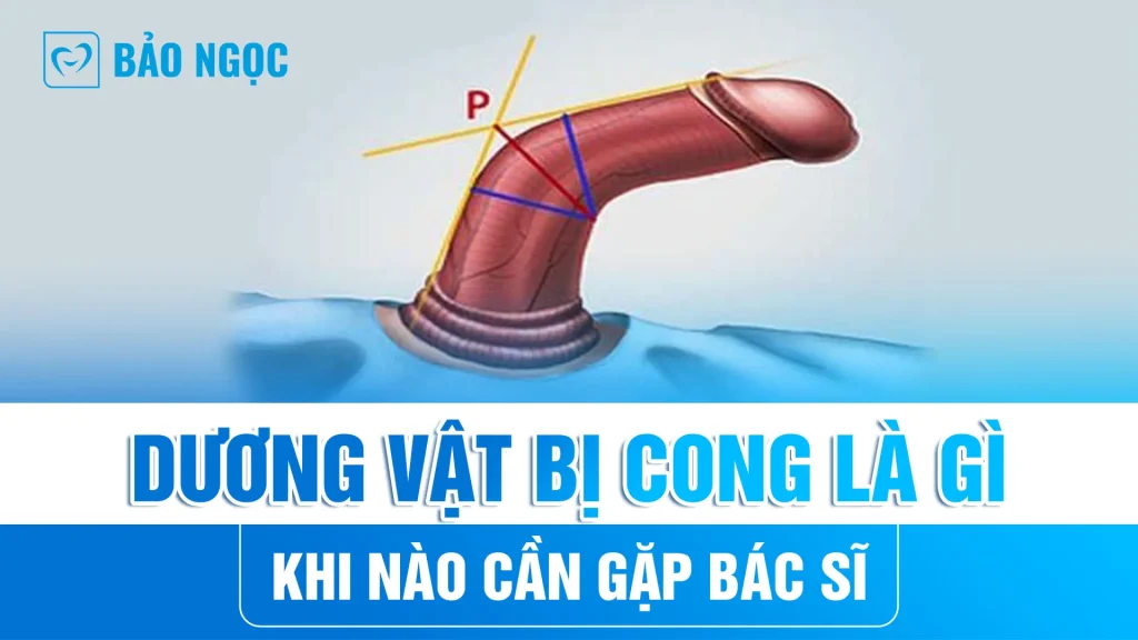 chữa dương vật bị cong