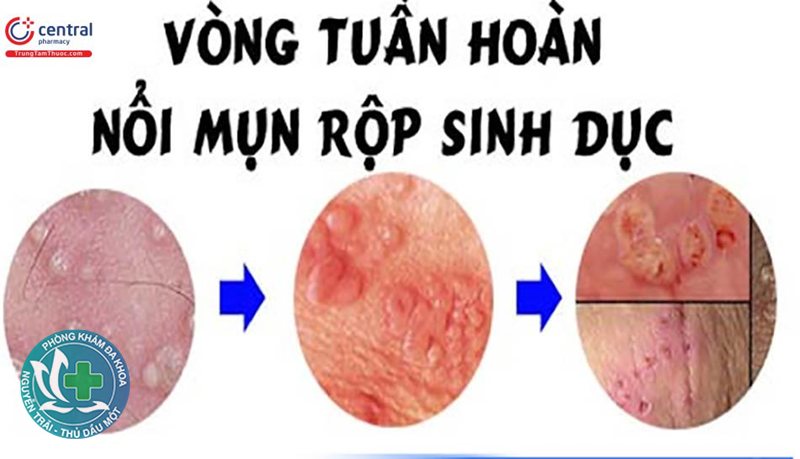 bệnh lậu ở nam - Tiểu buốt và tiểu rắt bất thường bệnh lậu ở nam - Tiểu buốt và tiểu rắt bất thường