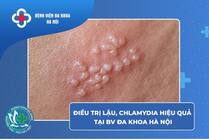 biểu hiện bệnh giang mai - Săng giang mai không đau biểu hiện bệnh giang mai - Săng giang mai không đau