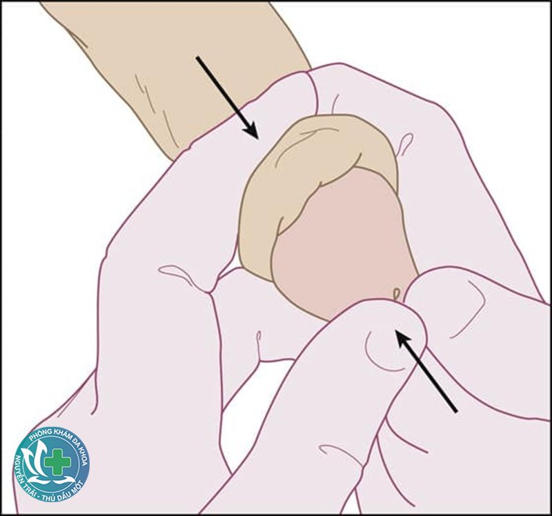 cắt bao quy đầu bao nhiêu tiền - Chi phí tái khám và chăm sóc sau thủ thuật