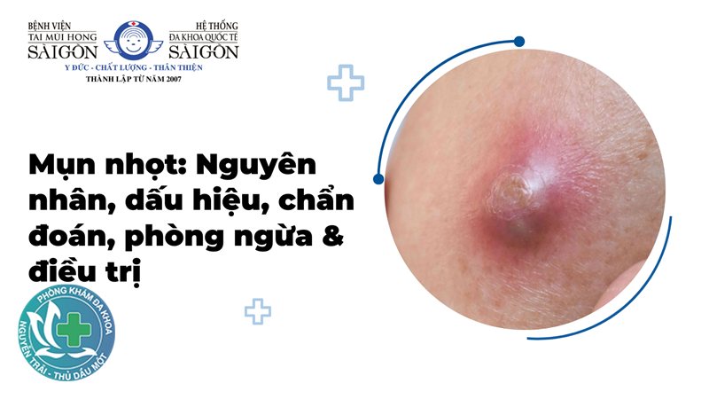 dấu hiệu bệnh lậu - Tiểu buốt và tiết dịch bất thường dấu hiệu bệnh lậu - Tiểu buốt và tiết dịch bất thường