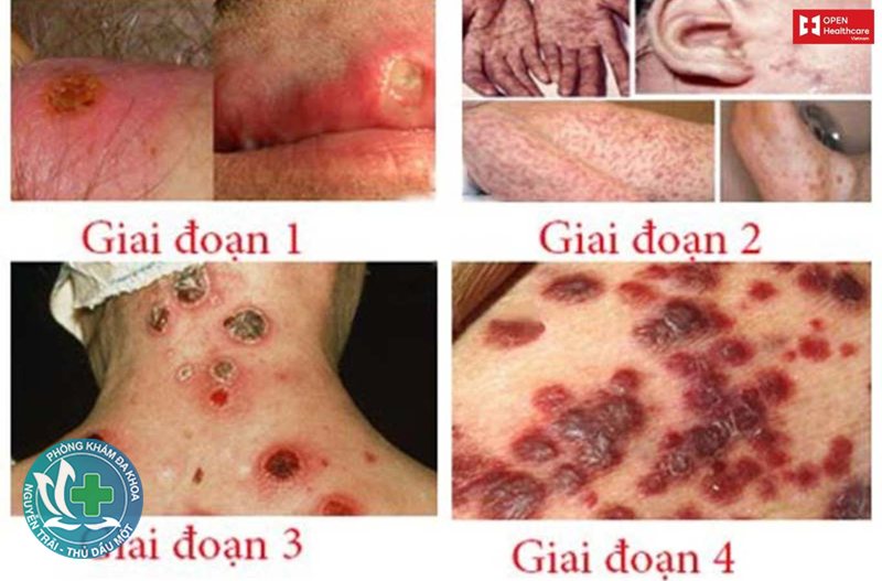 giang mai là bệnh gì - Bảng các giai đoạn bệnh giang mai và triệu chứng giang mai là bệnh gì - Bảng các giai đoạn bệnh giang mai và triệu chứng