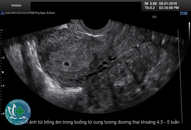 hút thai chân không là gì - Vì sao gọi là "chân không"
