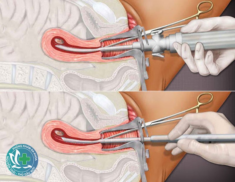 hút thai có hại không - Những rủi ro có thể gặp khi hút thai hút thai có hại không - Những rủi ro có thể gặp khi hút thai