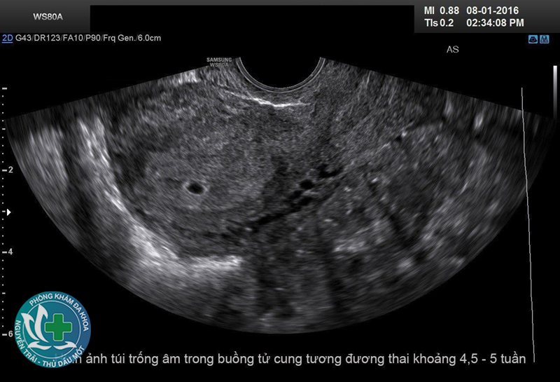 hút thai có hại không - Nguy cơ dính buồng tử cung hút thai có hại không - Nguy cơ dính buồng tử cung