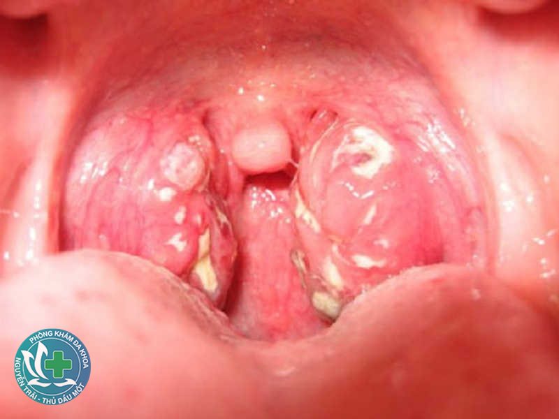 mụn rộp sinh dục có tự hết không - Thăm khám và điều trị bằng thuốc kháng virus