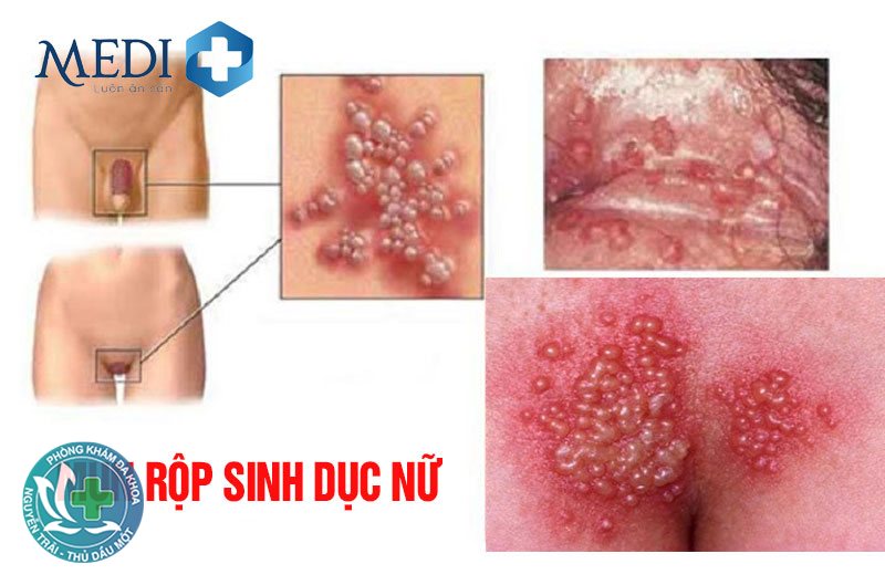 sùi mào gà ở lưỡi - Nốt sùi nhỏ màu hồng hoặc trắng
