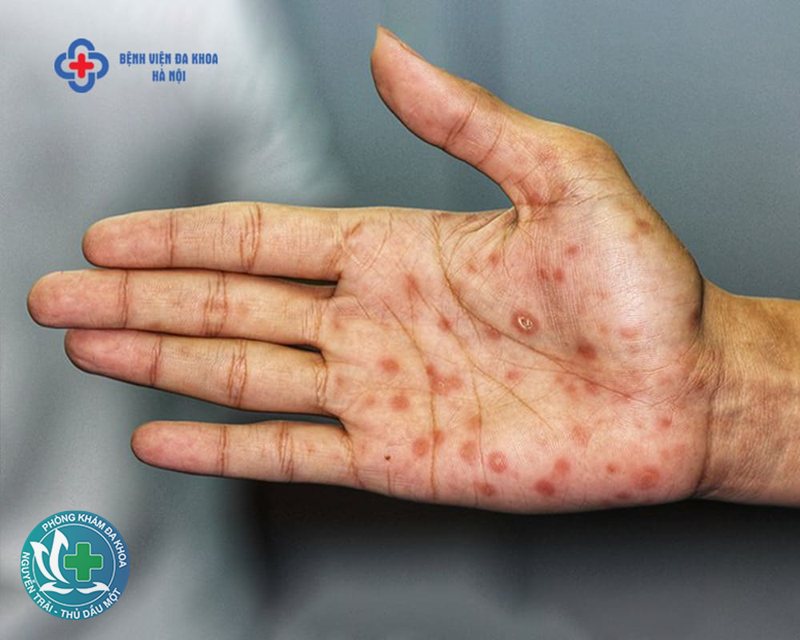 sùi mào gà ở nam - Bảng phân biệt các giai đoạn sùi mào gà ở nam sùi mào gà ở nam - Bảng phân biệt các giai đoạn sùi mào gà ở nam