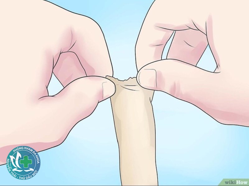 viêm mào tinh hoàn - Điều trị bằng kháng sinh theo chỉ định viêm mào tinh hoàn - Điều trị bằng kháng sinh theo chỉ định