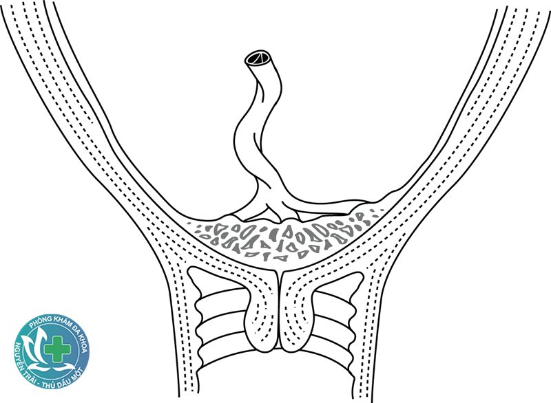 viêm phụ khoa tái đi tái lại - Nguyên nhân khiến viêm phụ khoa tái phát nhiều lần viêm phụ khoa tái đi tái lại - Nguyên nhân khiến viêm phụ khoa tái phát nhiều lần