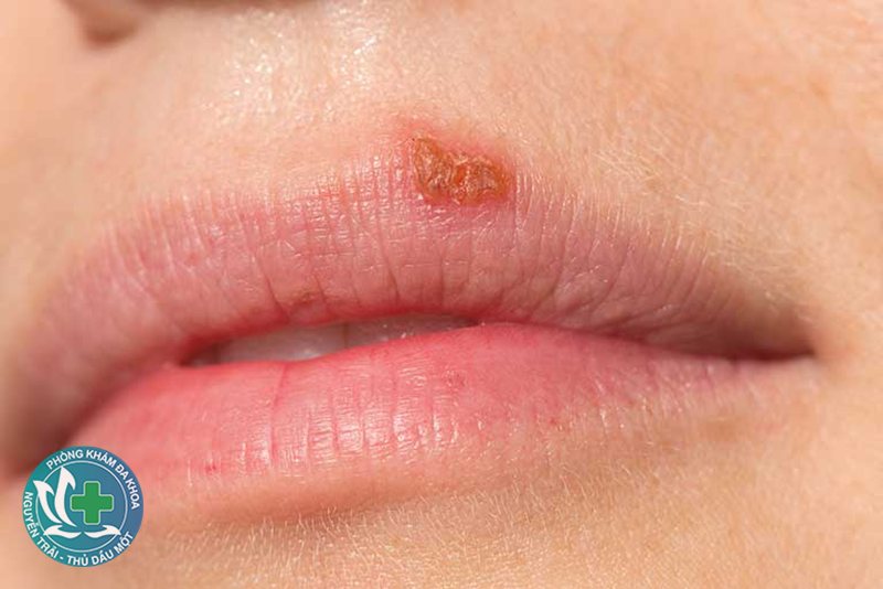 xét nghiệm bệnh xã hội hết bao nhiêu tiền - Xét nghiệm dịch tiết và mẫu bệnh phẩm xét nghiệm bệnh xã hội hết bao nhiêu tiền - Xét nghiệm dịch tiết và mẫu bệnh phẩm