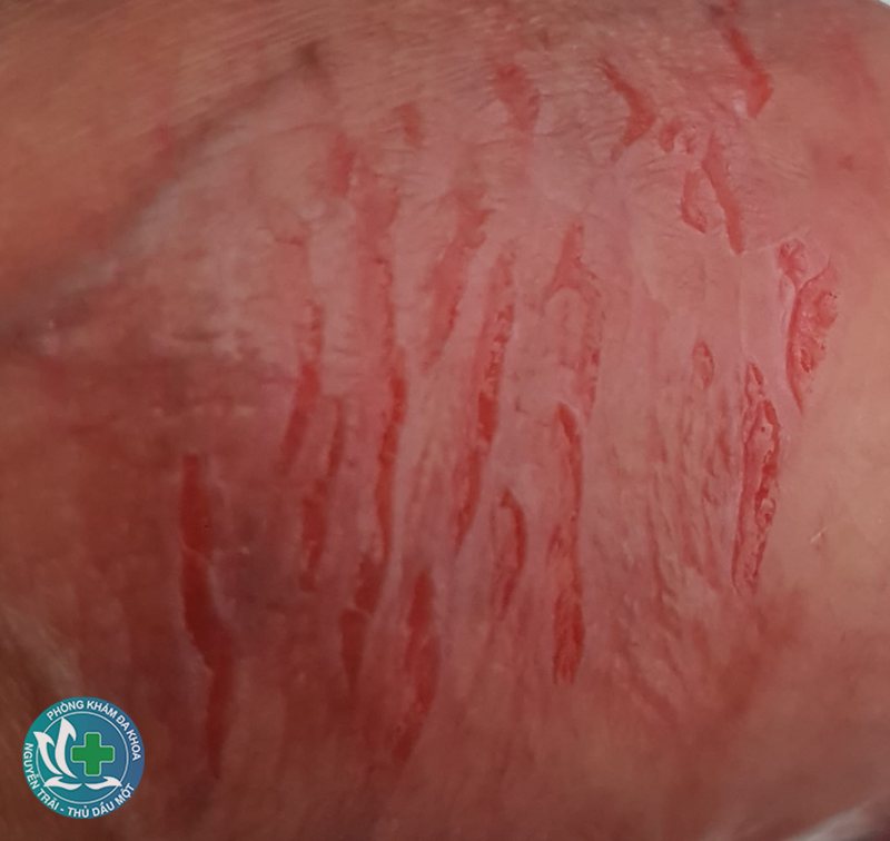 yếu sinh lý ở nam là gì - Nguyên nhân do tâm lý và lối sống