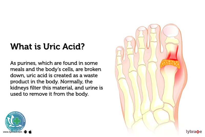 Acid uric - Acid uric cao có phải là gout? Acid uric - Acid uric cao có phải là gout?