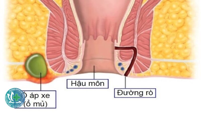 áp xe hậu môn có nguy hiểm không - Nhiễm trùng huyết áp xe hậu môn có nguy hiểm không - Nhiễm trùng huyết