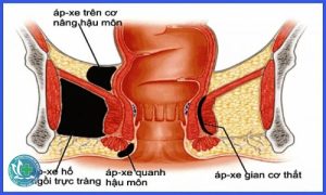 ap xe hau mon la gi 1