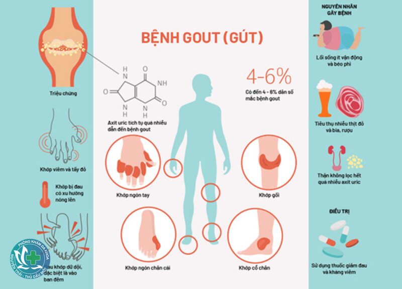 Bệnh gout - Cơn gout thường biểu hiện thế nào? Bệnh gout - Cơn gout thường biểu hiện thế nào?
