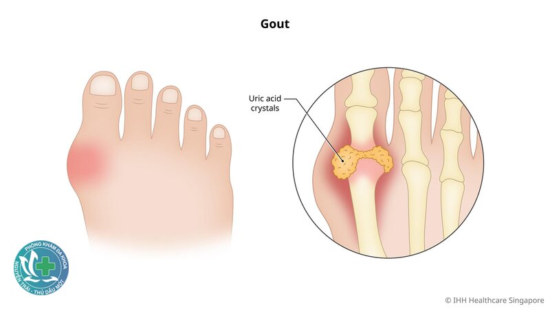 Bệnh gout - Chẩn đoán bệnh gout Bệnh gout - Chẩn đoán bệnh gout