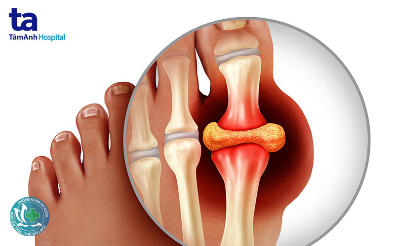 Bệnh gout - Ăn uống và lối sống Bệnh gout - Ăn uống và lối sống