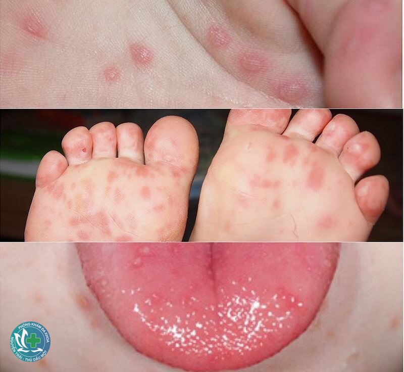 Bệnh tay chân miệng - Bệnh lây như thế nào? Bệnh tay chân miệng - Bệnh lây như thế nào?