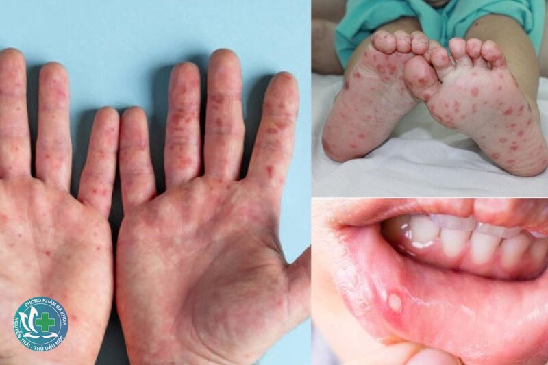 Bệnh tay chân miệng - Dấu hiệu bệnh có thể trở nặng Bệnh tay chân miệng - Dấu hiệu bệnh có thể trở nặng