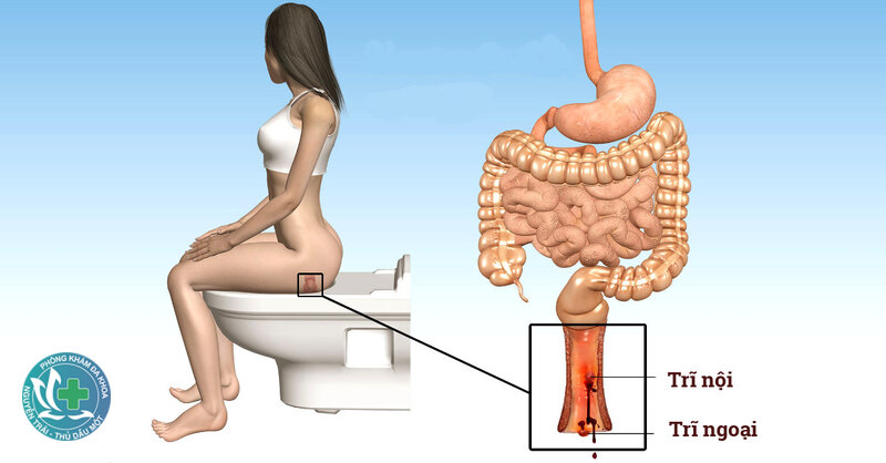 bệnh trĩ có nguy hiểm không - Trĩ không phải bệnh ác tính