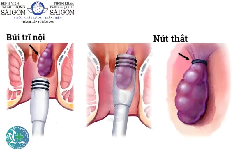 bệnh trĩ có nguy hiểm không - Trĩ nội và trĩ ngoại khác nhau thế nào về rủi ro