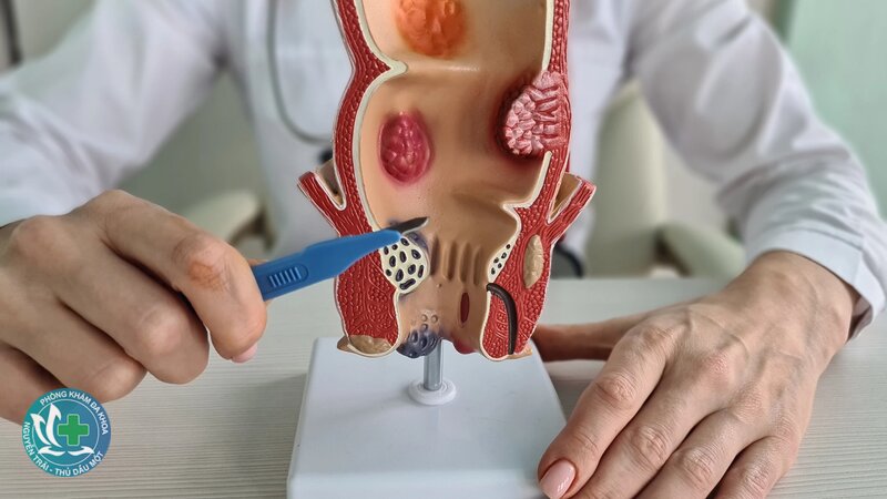 bệnh trĩ là gì - Bệnh trĩ là gì xét theo vị trí: trĩ nội, trĩ ngoại và trĩ hỗn hợp bệnh trĩ là gì - Bệnh trĩ là gì xét theo vị trí: trĩ nội, trĩ ngoại và trĩ hỗn hợp