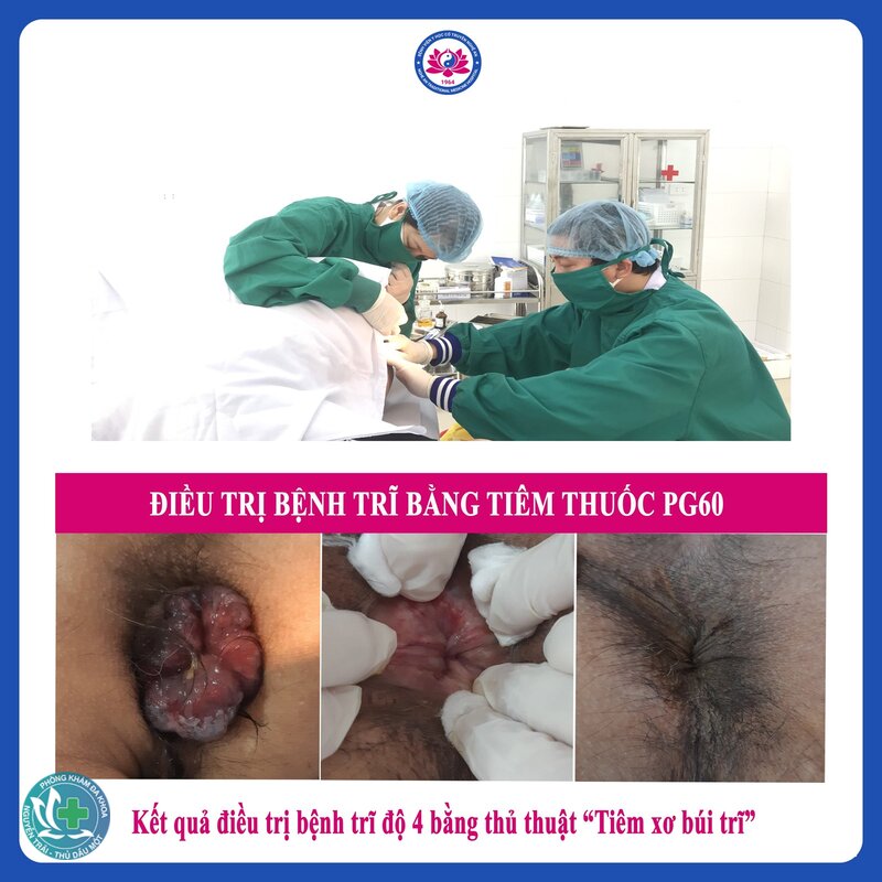 Búi trĩ là gì - Búi trĩ có tự hết không? Búi trĩ là gì - Búi trĩ có tự hết không?