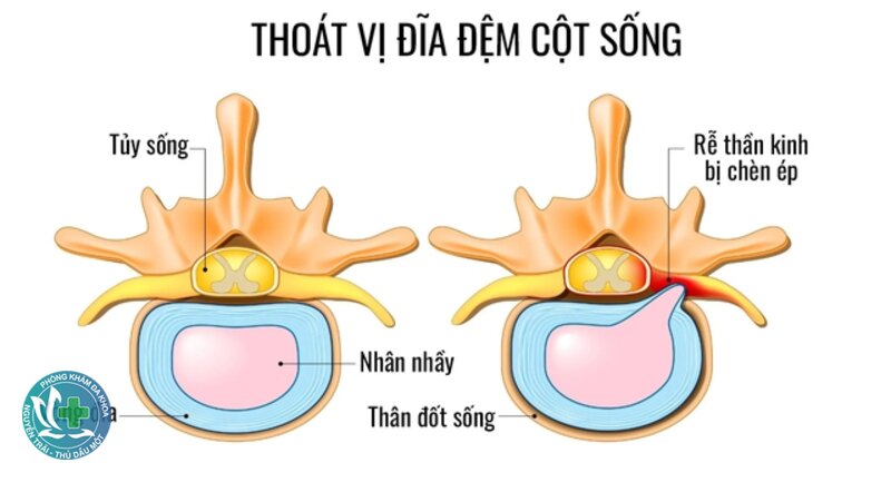 Dấu hiệu thoát vị đĩa đệm - Thoát vị đĩa đệm là gì? Dấu hiệu thoát vị đĩa đệm - Thoát vị đĩa đệm là gì?