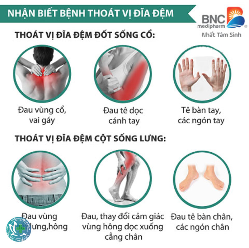 Dấu hiệu thoát vị đĩa đệm - Dấu hiệu thoát vị đĩa đệm cổ Dấu hiệu thoát vị đĩa đệm - Dấu hiệu thoát vị đĩa đệm cổ
