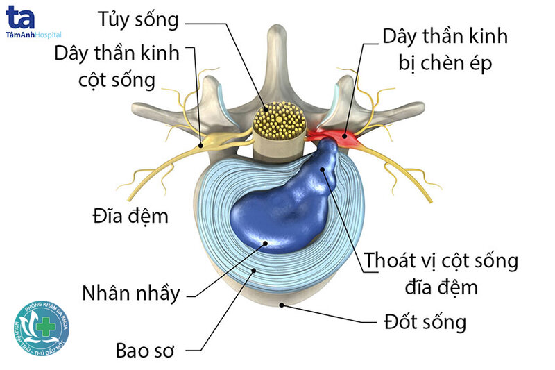 Dấu hiệu thoát vị đĩa đệm - Khi nào nên đi khám sớm? Dấu hiệu thoát vị đĩa đệm - Khi nào nên đi khám sớm?